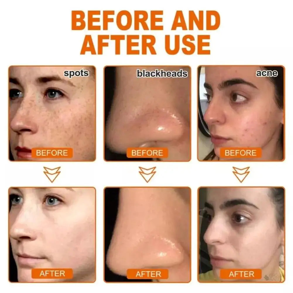 Pack of 2 Spots Blemish Clearing Peel Off Mask Anti-Blemish Freckle Glowing Mask Tear-Off Face Mask Moisturizing Pore Tightening